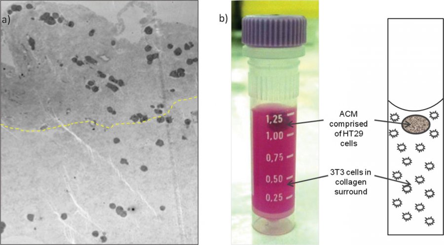 Tumoroid consisting of an artifi cial cancer mass (ACM):stromal surrounding GNP
concentration ratio 5:1, the ACM of approximate concentration 0.02 mgAu/mL. a) Microscopic
appearance (TEM) of tumoroid photographed in (b). The boundary between ACM and stroma
is evident as a difference in collagen density, the greatest difference in collagen greyscale
mapped as a dashed line to estimate the cancer/stromal boundary; collagen is more dense
within the ACM (above dashed line) and stromal collagen less dense (below dashed line).
GNP containing vesicles are visible within the cells Tumoroid consisting of an artifi cial cancer mass (ACM):stromal surrounding GNP
concentration ratio 5:1, the ACM of approximate concentration 0.02 mgAu/mL. a) Microscopic
appearance (TEM) of tumoroid photographed in (b). The boundary between ACM and stroma
is evident as a difference in collagen density, the greatest difference in collagen greyscale
mapped as a dashed line to estimate the cancer/stromal boundary; collagen is more dense
within the ACM (above dashed line) and stromal collagen less dense (below dashed line).
GNP containing vesicles are visible within the cells