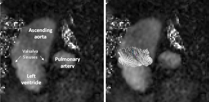 Intravascular fluid dynamic from Magnetic Resonance Imaging (left panel: left ventricle and ascending aorta anatomy; right panel: velocity vectors in the supra valvular plane)